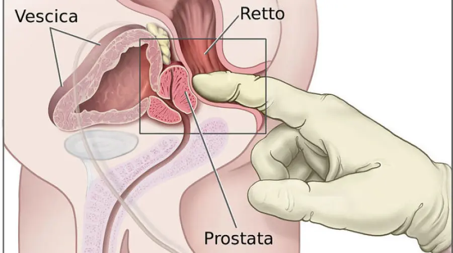 Rimedi naturali per curare la prostatite