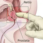 Rimedi naturali per curare la prostatite