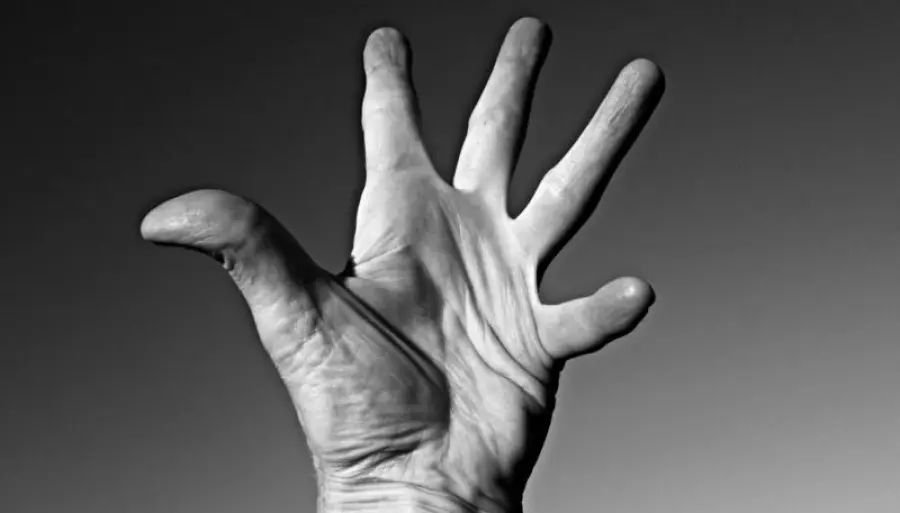 Miglior terapia per l'artrite