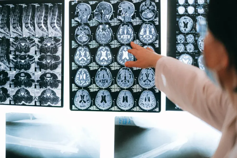 Patologie neurologiche: comprendere i disturbi che coinvolgono il sistema nervoso