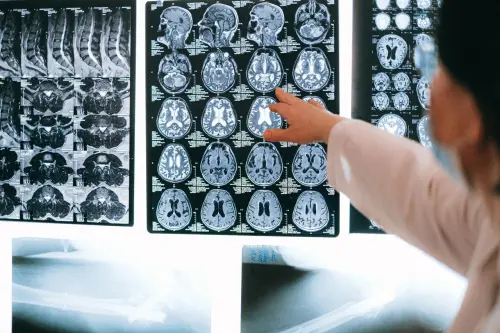 Patologie neurologiche: comprendere i disturbi che coinvolgono il sistema nervoso